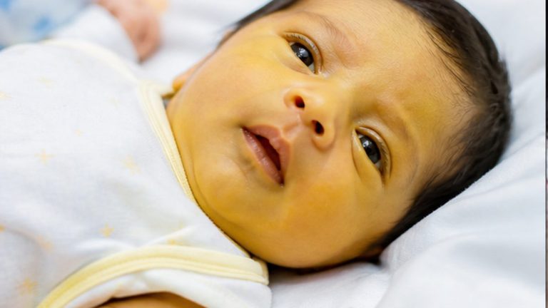 Newborn Jaundice: How to Recognise It and When Treatment Is Needed